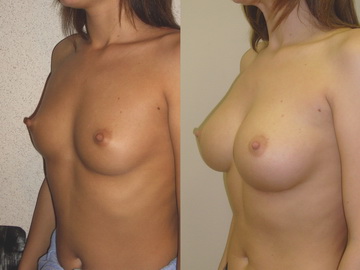 увеличение груди
